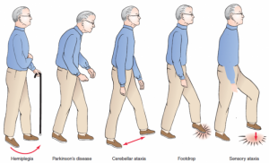 How To Cure And What To Avoid In Parkinson’s Disease?