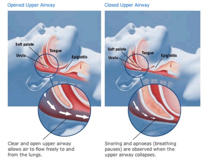 How To Get Rid Of Snoring Problem Once And For All