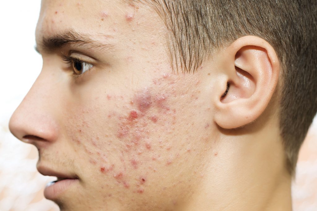 9 Face Mapping Acne Spots And What Every Acne Spot Means 