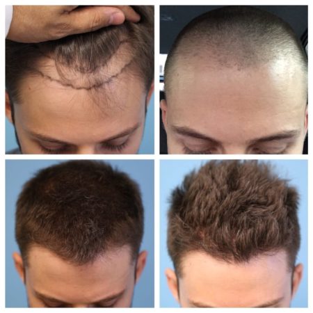 Top 10 Hair Transplant Clinics In The USA