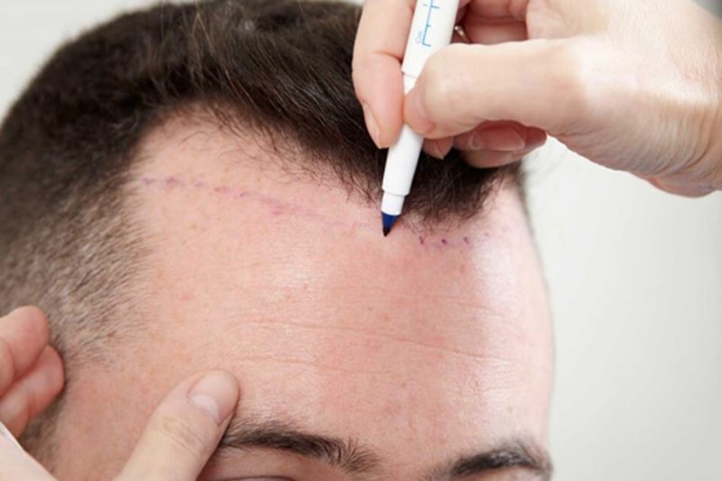 Best 10 Hair Transplant Clinics In Dubai