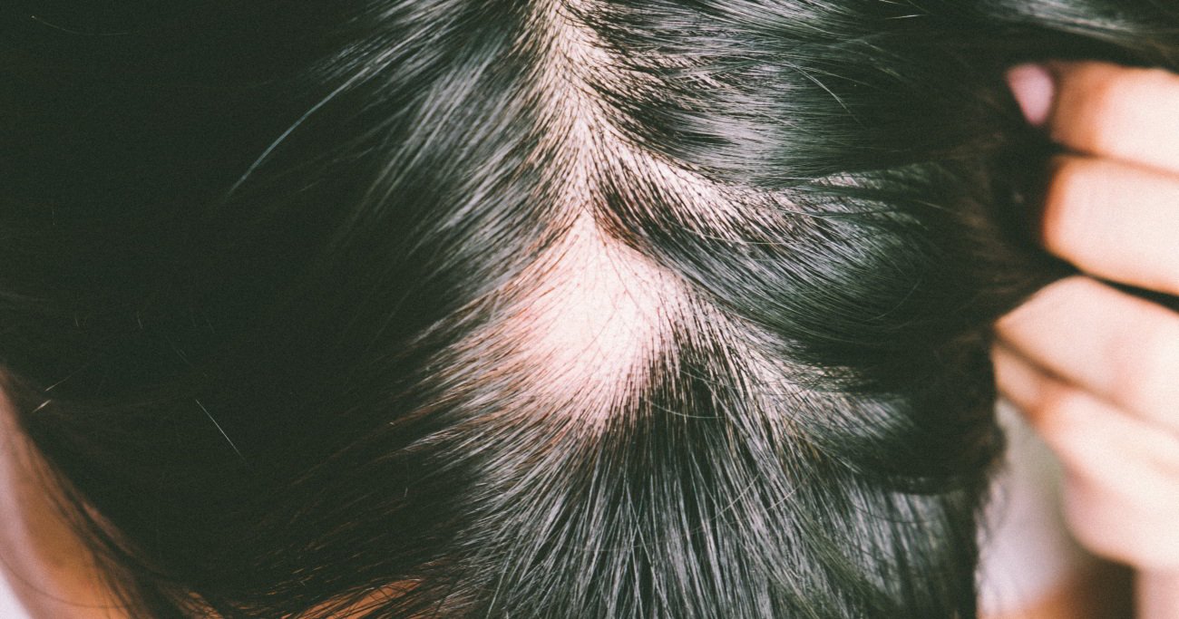 Alopecia Areata Top 7 Causes of Hair Loss: Symptoms and Causes of Alopecia - 5