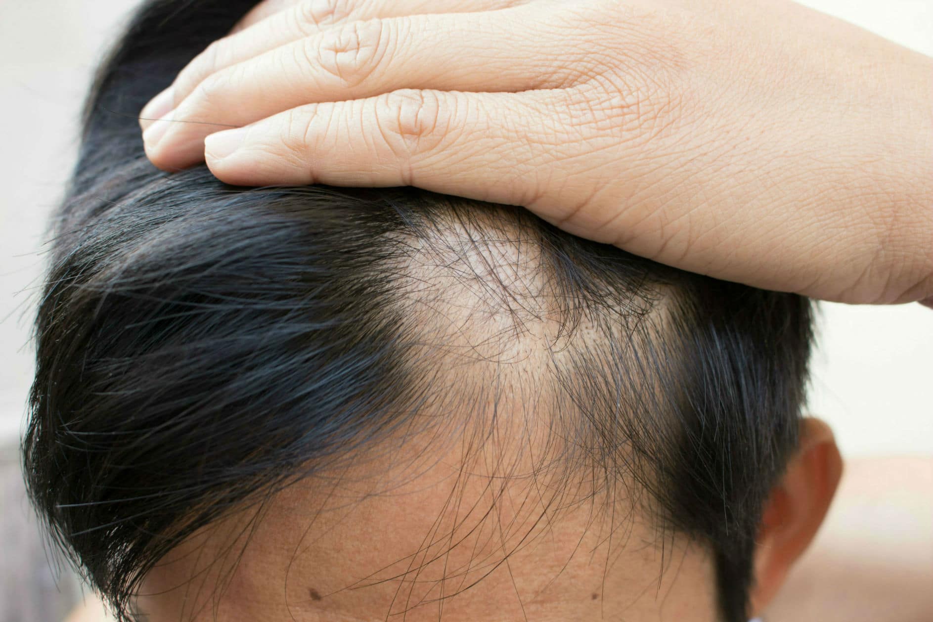 Poor Haircare Practices and Traction Alopecia Top 7 Causes of Hair Loss: Symptoms and Causes of Alopecia - 9